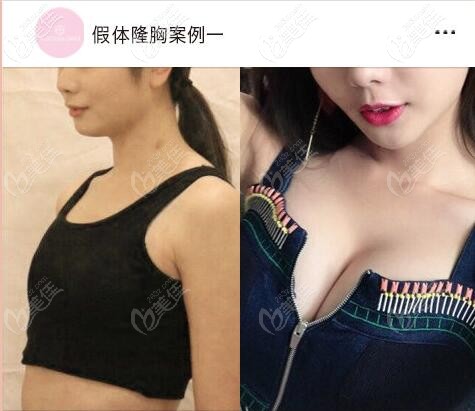 中山伊美神假体隆胸案例 中山伊美神假体隆胸案例