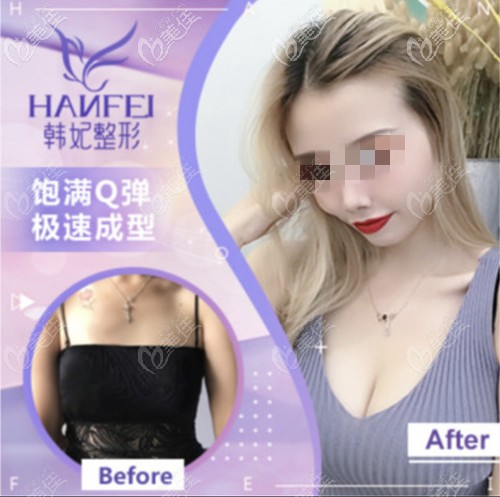 中山韩美假体隆胸案例 中山韩美假体隆胸案例