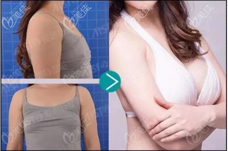 中山爱思特假体隆胸案例 中山爱思特假体隆胸案例