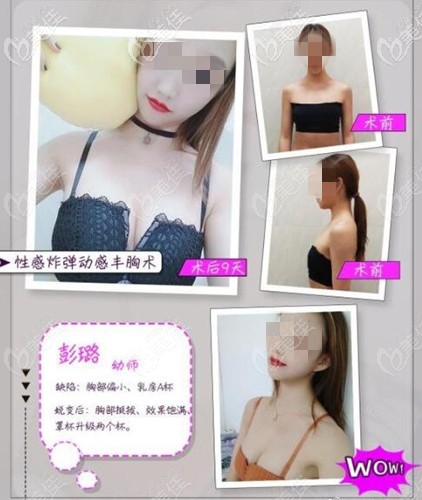 中山尼姬假体隆胸案例 中山尼姬假体隆胸案例