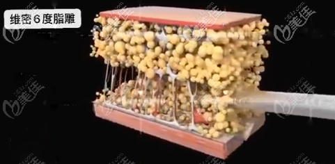 维密6度脂雕吸脂示意图 维密6度脂雕吸脂示意图