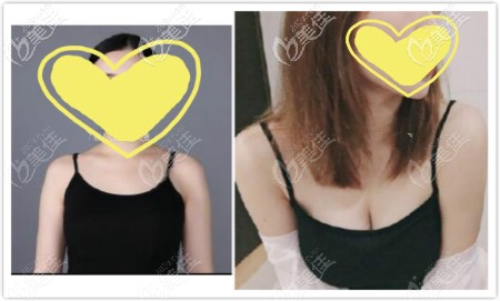 极速果冻丰胸恢复一年前后对比图 极速果冻丰胸恢复一年前后对比图