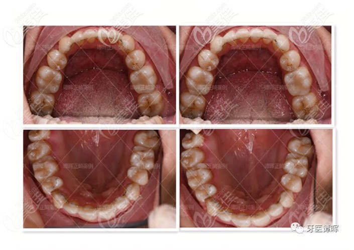 27岁门牙外凸的小哥哥带钢牙套矫正两年后的经验分享