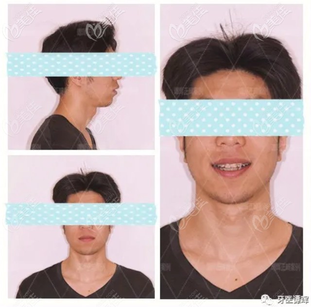 矫正10个月的效果图 矫正10个月的效果图