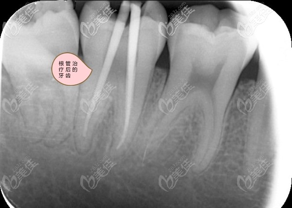 根管治疗后的牙齿拍片图 根管治疗后的牙齿拍片图