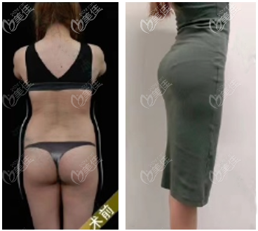 我花6万多做的维密6°脂雕吸脂瘦腰腹案例效果