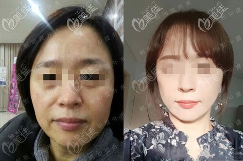 柳民熙3d童颜术案例