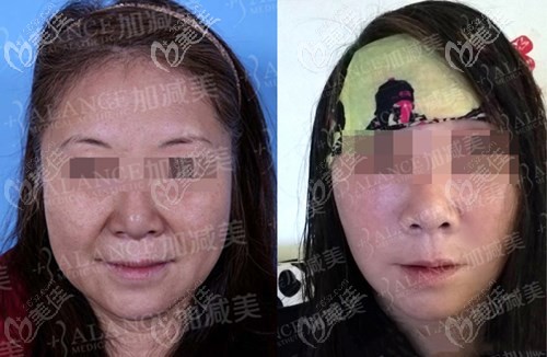 穆宝安V美减龄面部提升案例