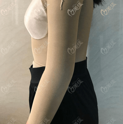 我在北京做手臂吸脂好的雅靓医院做完手术第8天 我在北京做手臂吸脂好的雅靓医院做完手术第8天