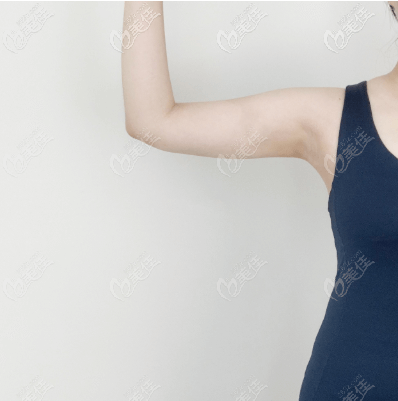 我做手臂吸脂术后十多天恢复图 我做手臂吸脂术后十多天恢复图