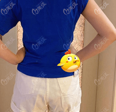 找北京做手臂吸脂好的医生陈林叶做完手术有84天了 找北京做手臂吸脂好的医生陈林叶做完手术有84天了