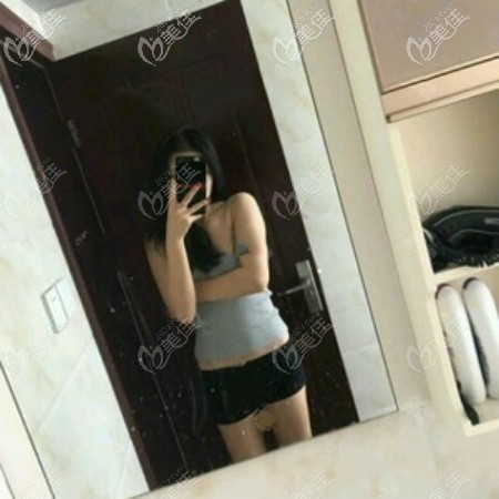 肚子吸脂15天恢复效果图：半个月了一点没效果