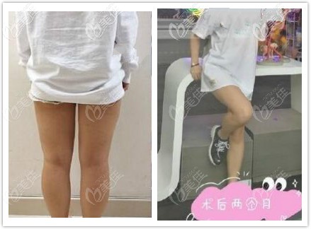 大腿吸脂三个月腿围细了10厘米 大腿吸脂三个月腿围细了10厘米