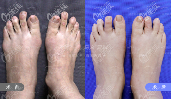 拇外翻综合整形+小脚骨祛除+二趾缩短案例 拇外翻综合整形+小脚骨祛除+二趾缩短案例