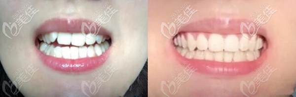 为何她在广州穗江口腔戴金属自锁牙套矫正下牙齿内倾后，逢人就安利正畸？