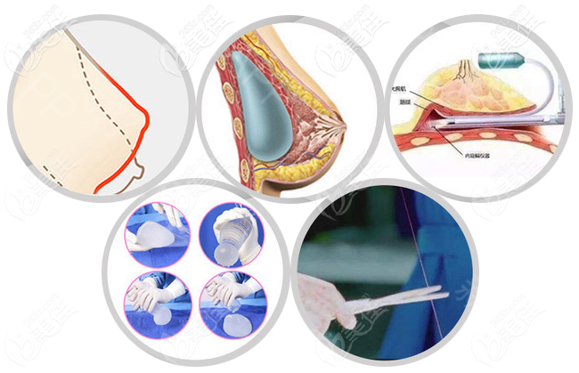 赵宏伟医生隆胸技术怎么样 赵宏伟医生隆胸技术怎么样