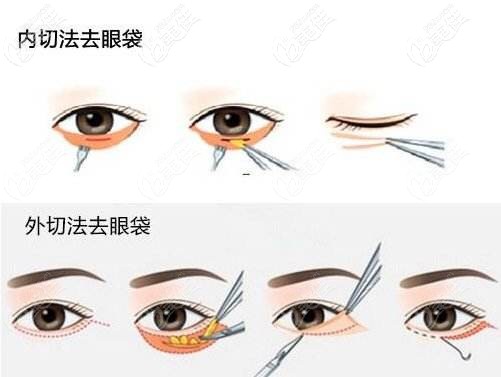 内切和外切去眼袋手术 内切和外切去眼袋手术
