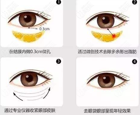 激光祛眼袋 激光祛眼袋