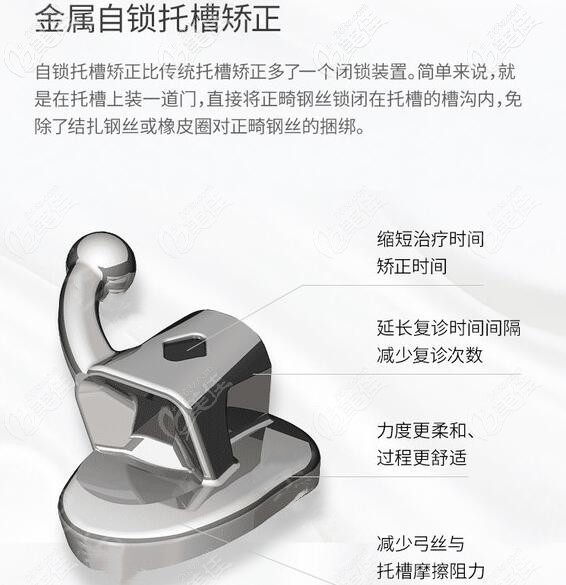 广州穗江口腔金属自锁托槽矫正器 广州穗江口腔金属自锁托槽矫正器