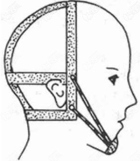 头帽与牵引颏兜矫正装置 头帽与牵引颏兜矫正装置