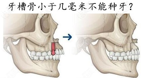 牙槽骨小于几毫米不能种牙