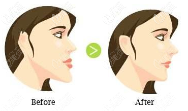 地包天矫正前后动画对比图 地包天矫正前后动画对比图