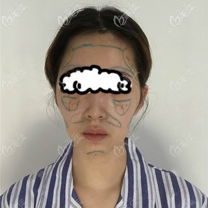 <!--<i data=20240703-sp></i>-->时光王彬做脂肪填充脸部划线样子