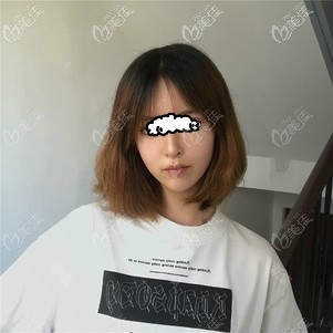 <!--<i data=20240703-sp></i>-->时光王彬自体脂肪填充脸部10天脸好丑