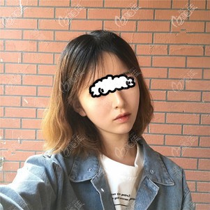 我到时光做自体脂肪填充面部,10天脸好圆,3个月后变成了心形少女脸