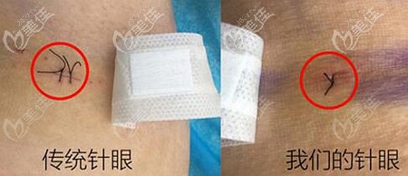 绵阳朗睿的吸脂优势 绵阳朗睿的吸脂优势