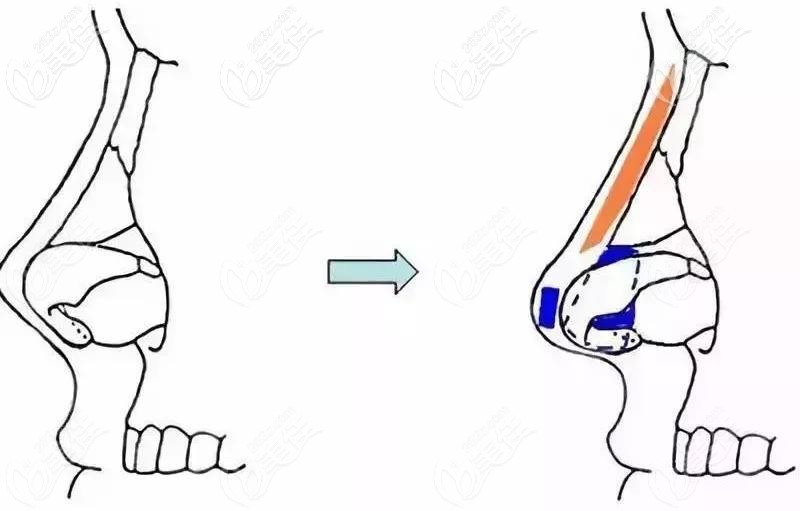 肋骨隆鼻失败修复手术 肋骨隆鼻失败修复手术