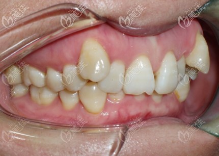 我矫正前的牙齿情况 我矫正前的牙齿情况