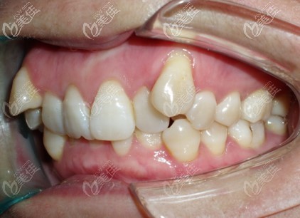深覆合加牙齿拥挤的侧面照 深覆合加牙齿拥挤的侧面照