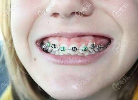 牙列拥挤+深覆合矫正效果你值得一看,花费两年时间也值得！