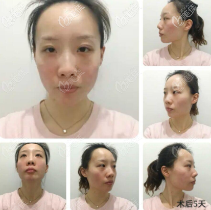 第五天脸还有点儿红