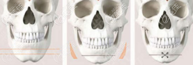 长脸缩短手术示意图 长脸缩短手术示意图