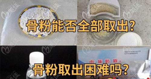 骨膜贴片和骨粉成分相同都很难取出