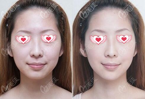 北京米兰柏羽丽都石冰面部埋线提升真人前后对比照 北京米兰柏羽丽都石冰面部埋线提升真人前后对比照