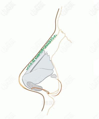 骨膜贴片和骨粉成分相似