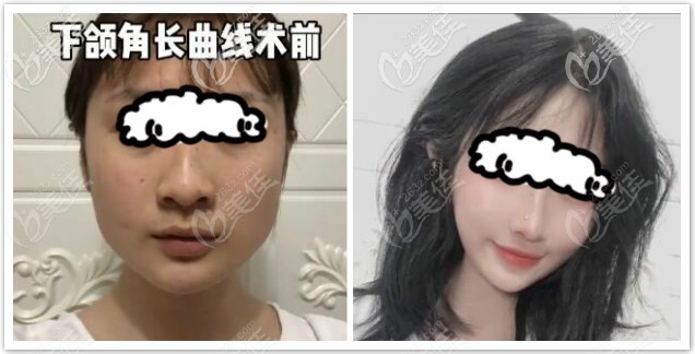 韩国磨骨医生张柱允下颌角颧骨磨骨案例一年后效果对比图