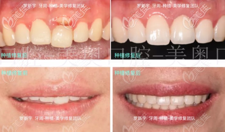这是我在常州美奥口腔刚做完前门牙即刻种植的效果