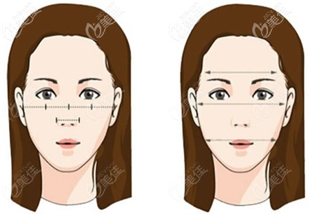 颧骨手术可以改善面部的比例