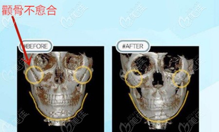 颧骨磨骨失败修复手术效果