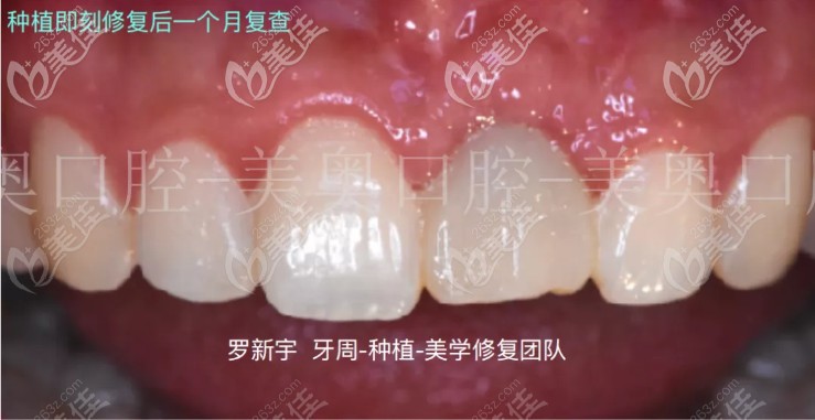 即刻种植一个月后的复查图片 即刻种植一个月后的复查图片