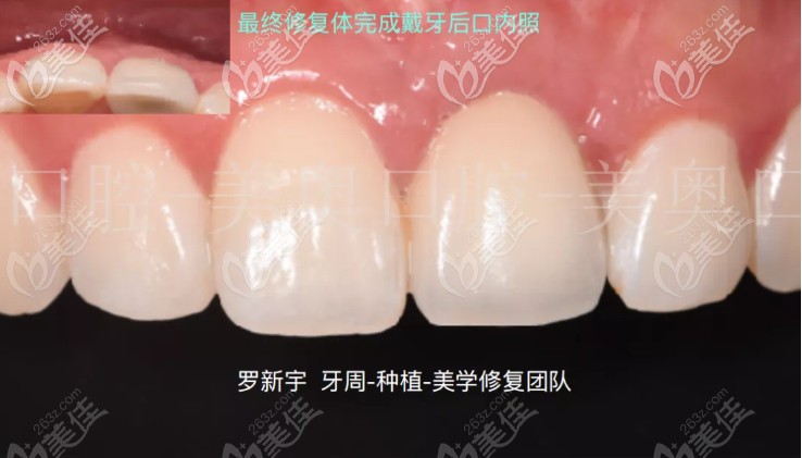 即刻种植牙已经完成 即刻种植牙已经完成