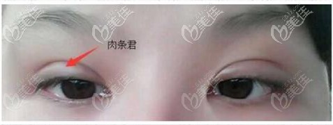 眼部有肉条感