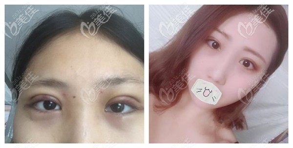 雅芳亚整形做双眼皮修复案例