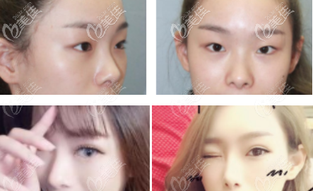 深圳希思双眼皮案例