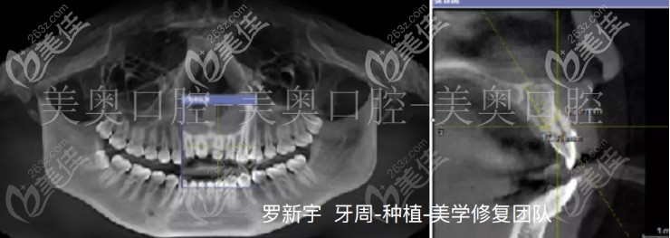 我的术前片子 我的术前片子