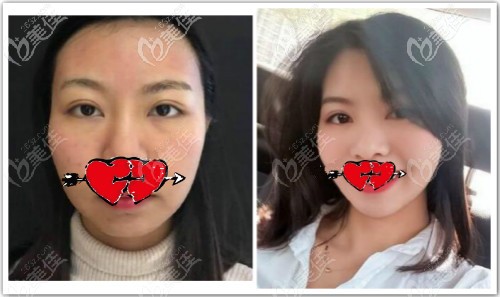 面部微创悬吊提升术前后对比